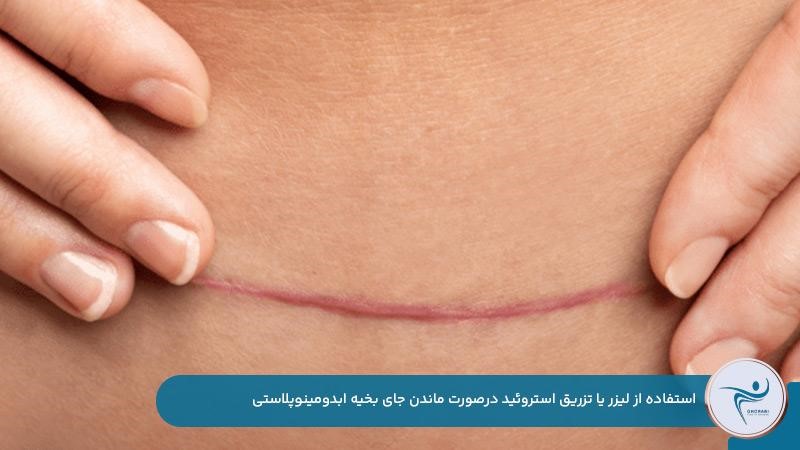 انجام لیزر یا تزریق استروئید در صورت ماندن جای بخیه ابدومینوپلاستی
