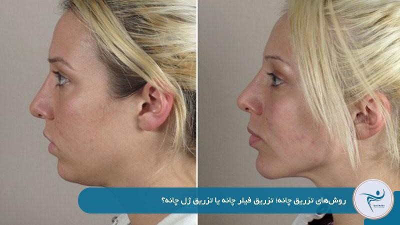 انواع روش‌های تزریق چانه 