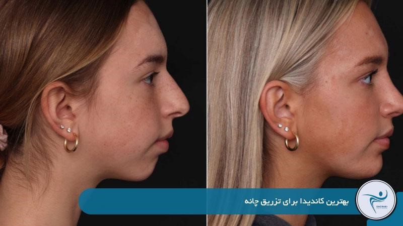 بهترین کاندیدا برای تزریق چانه 