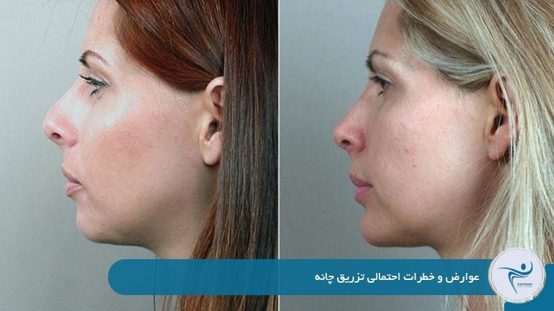 عوارض و خطرات احتمالی تزریق چانه 