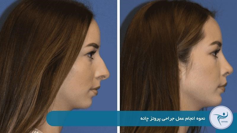 عمل پروتز چانه چگونه است؟ این جراحی به عنوان نوعی عمل زیبایی صورت معمولا تحت بی‌حسی موضعی یا بیهوشی عمومی انجام می‌شود و بسته به تکنیک انتخابی، برش از طریق دهان یا زیر چانه انجام می‌گیرد. سپس پزشک فضای مورد نیاز را در جلوی استخوان فک پایین ایجاد کرده و پروتز را در جای خود قرار می‌دهد. مراحل کلی جراحی این جراحی به شرح زیر است: بررسی و انتخاب نوع مناسب پروتز آماده‌سازی بیمار و بی‌حسی یا بیهوشی ایجاد برش داخلی یا خارجی جای‌گذاری پروتز چانه بخیه و پانسمان در صورت تمایل به جراحی ملایم‌تر، برخی از بیماران گزینه‌ عمل پروتز چانه بدون بیهوشی را انتخاب می‌کنند که البته باید با پزشک مشورت شود. 