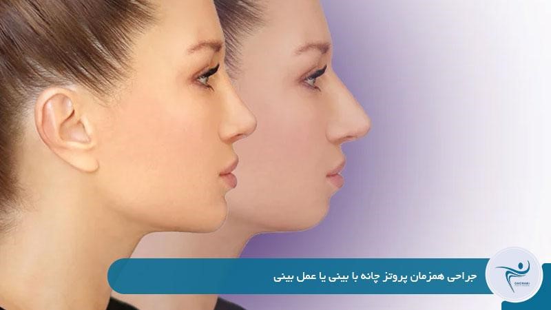 ترکیب چند جراحی زیبایی، مثل جراحی پروتز چانه با رینوپلاستی (عمل بینی)، یکی از تکنیک‌های رایج برای ایجاد تعادل کلی در چهره است. در بیشتر موارد، پزشک برای رسیدن به نتایج ایده‌آل، عمل زیبایی صورت را به‌ شکل ترکیبی انجام می‌دهد: پروتز چانه + عمل بینی پروتز چانه + لیفت صورت پروتز چانه + لیپوساکشن غبغب توصیه می‌شود برای ارزیابی دقیق، با یک دکتر زیبایی تهران مشورت کنید که در زمینه جراحی‌های ترکیبی تجربه کافی دارد.