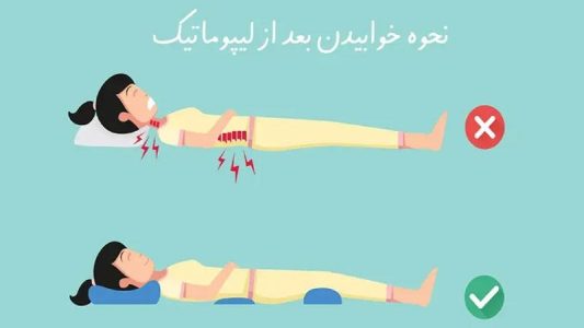 مهم‌ترین نکات خوابیدن بعد از عمل لیپوماتیک