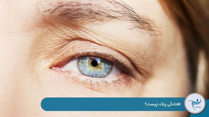 افتادگی پلک چیست؟