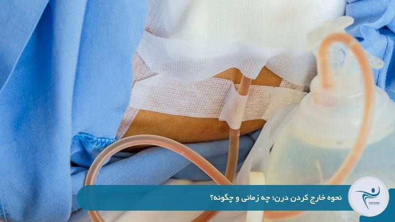 نحوه خارج کردن درن؛ چه زمانی و چگونه؟