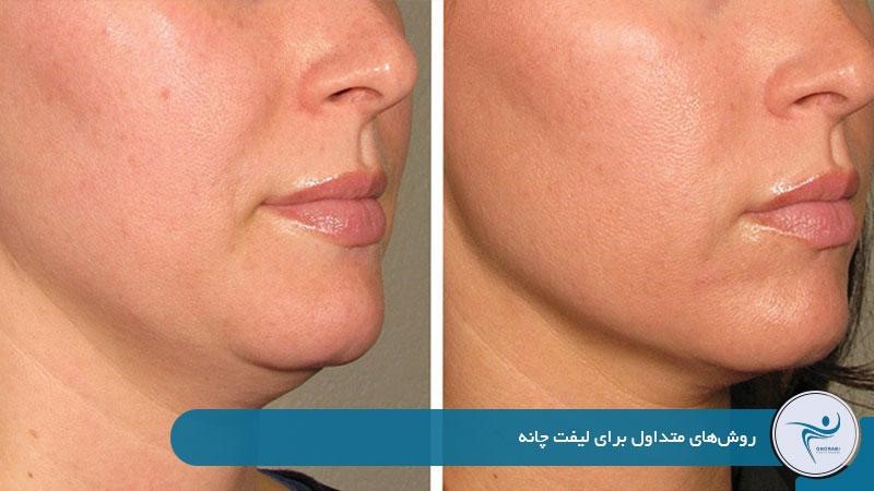 روش‌های متداول برای لیفت چانه 
