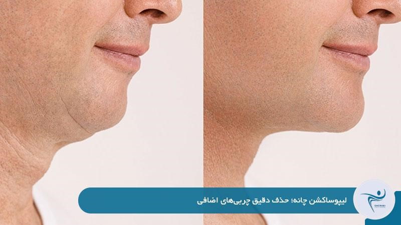 لیپوساکشن چانه؛ حذف دقیق چربی‌های اضافی 