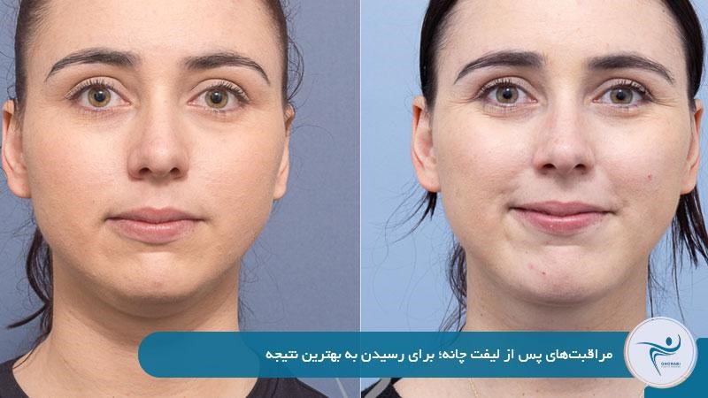 مراقبت‌های پس از لیفت چانه 