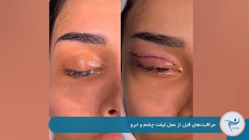 مراقبت‌های قبل از عمل لیفت چشم و ابرو 
