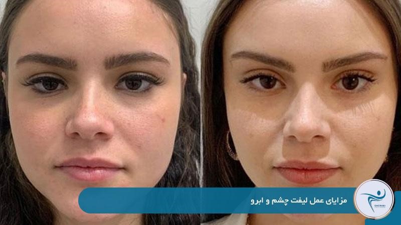 مزایای عمل لیفت چشم و ابرو 