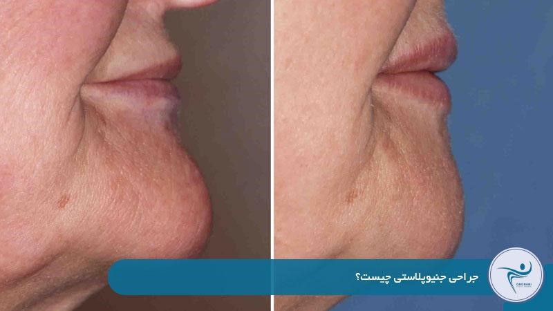 جراحی جنیوپلاستی چیست؟ 