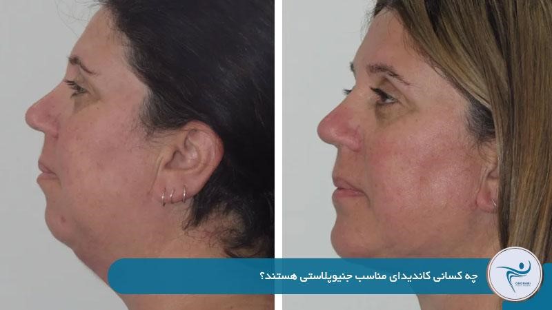 چه کسانی کاندیدای مناسب جنیوپلاستی هستند؟ 