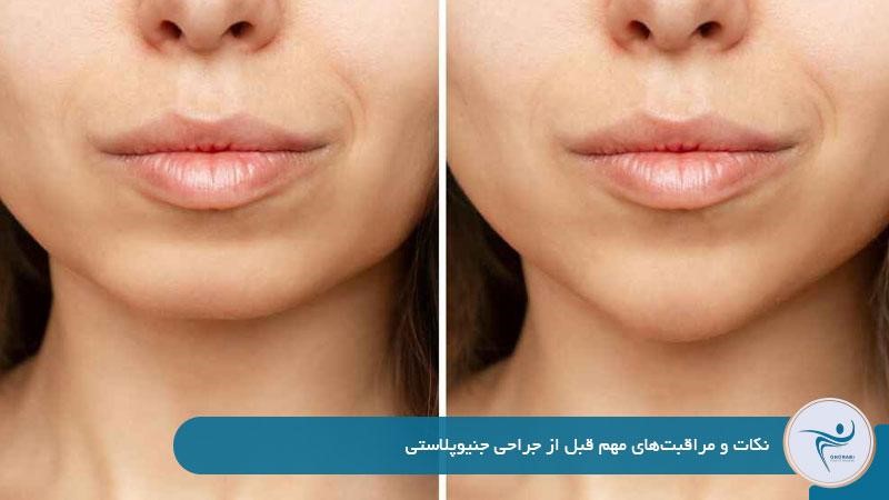 نکات و مراقبت‌های مهم قبل از جراحی جنیوپلاستی 