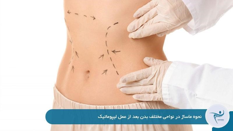 نحوه ماساژ در نواحی مختلف بدن بعد از عمل لیپوماتیک