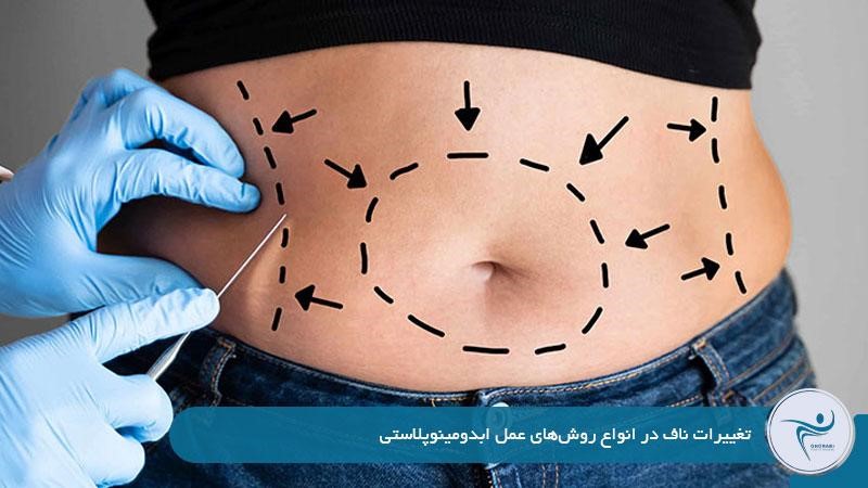 تغییرهای ناف در عمل ابدومینوپلاستی