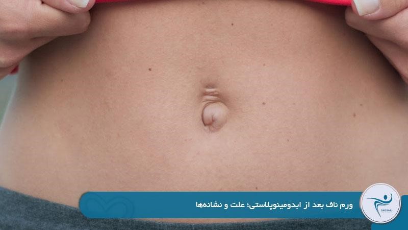علت ورم ناف بعد از عمل ابدومینوپلاستی