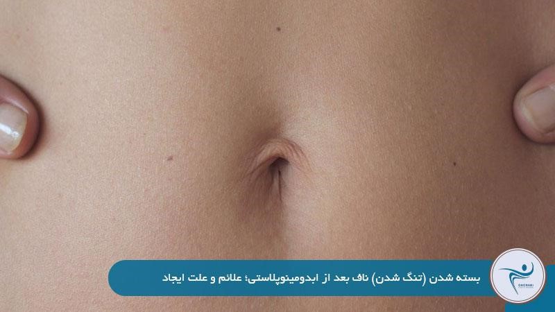 علت بسته شدن یا تنگ شدن ناف بعد از ابدومینوپلاستی