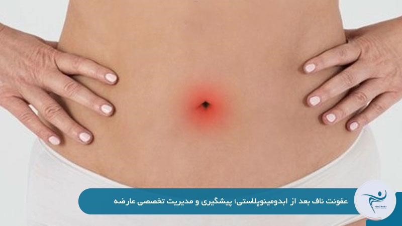 علت عفونت ناف بعد از ابدومینوپلاستی