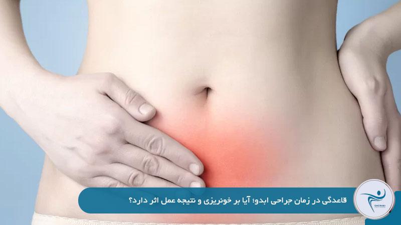 پریودی در زمان جراحی ابدو؛ آیا امکان‌پذیر است؟