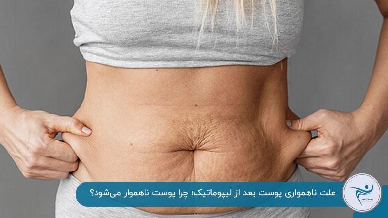 علت ناهمواری پوست بعد از لیپوماتیک