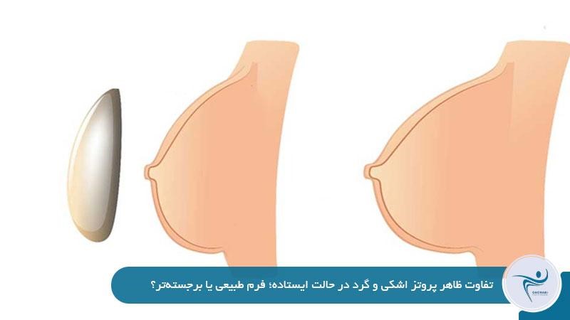 تفاوت ظاهر پروتز اشکی و گرد در حالت ایستاده