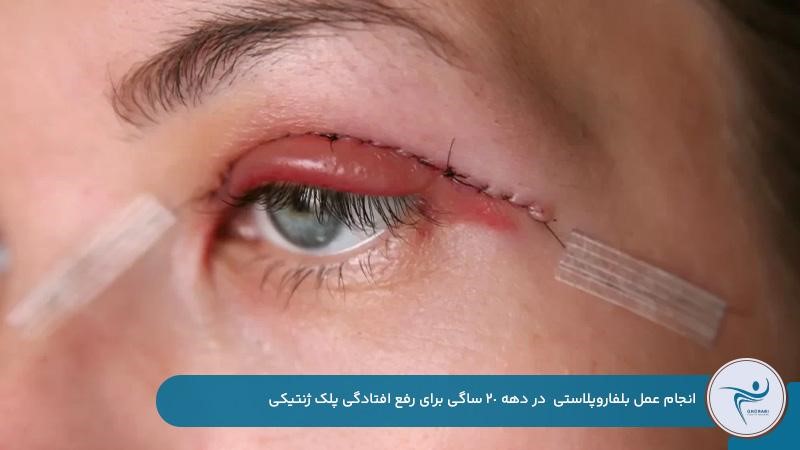 رفع افتادگی پلک ژنتیکی با انجام عمل بلفاروپلاستی در سن 20 سالگی