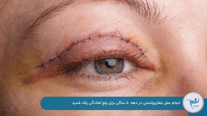انجام عمل بلفاروپلاستی در سن 50 سالگی برای بهتر شدن میدان دید