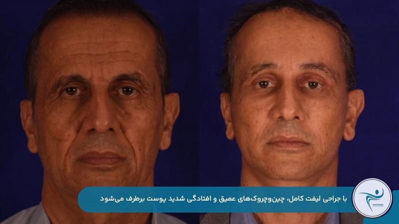 جراحی لیفت بهترین روش جوانسازی و لیفت صورت