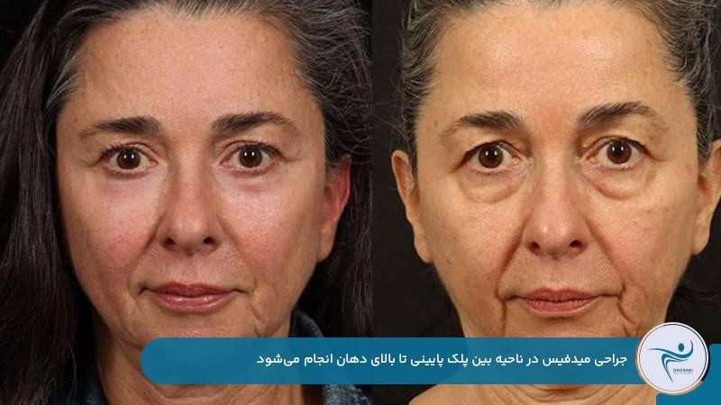 انجام جراحی میدفیس در بخش میانی صورت برای جوانسازی و لیفت