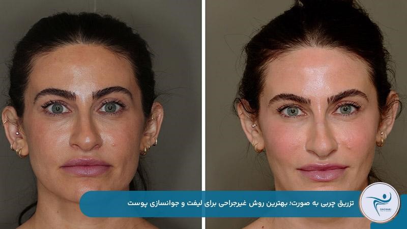 تزریق چربی بهترین روش جوانسازی و لیفت صورت