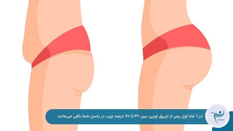 ماندگاری ۳۰ تا ۷۰ درصد چربی تزریق شده به باسن