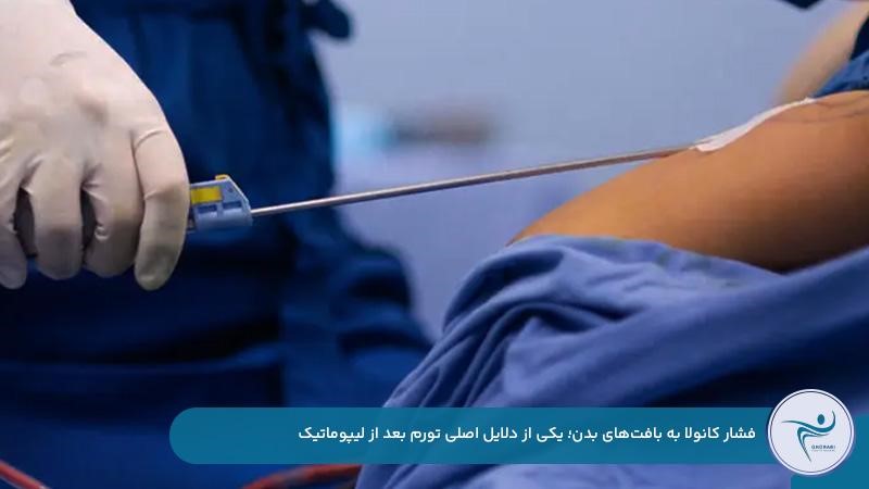 ورم بعد از لیپوماتیک به دلیل فشار کانولا به بافت‌های بدن