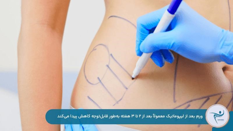 کاهش ورم بعد از لیپوماتیک بعد از 6 ماه