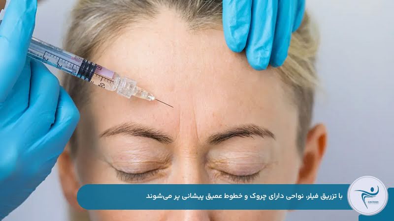 کاهش چروک پیشانی با تزریق فیلر