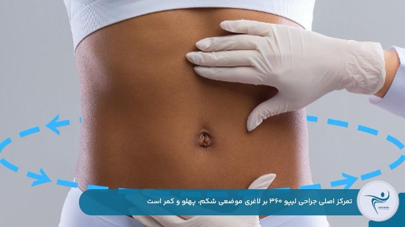 لاغری موضعی شکم، کمر و پهلو با جراحی لیپو 360
