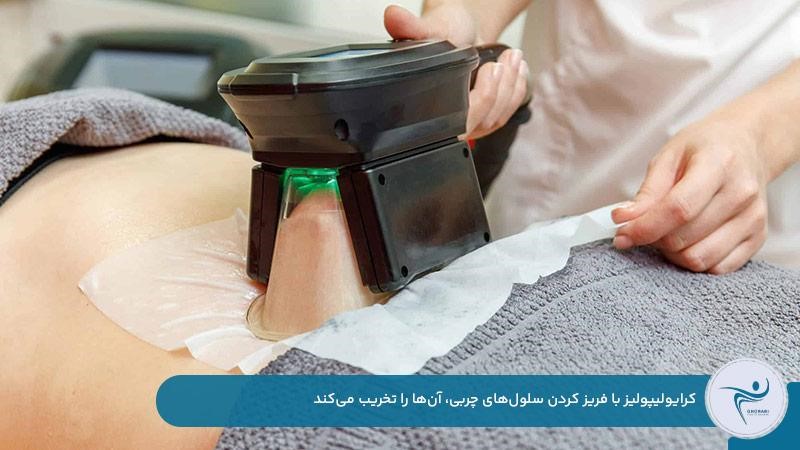 دستگاه کرایولیپولیز برای لاغری موضعی شکم با تخریب چربی‌ها به‌وسیله سرما