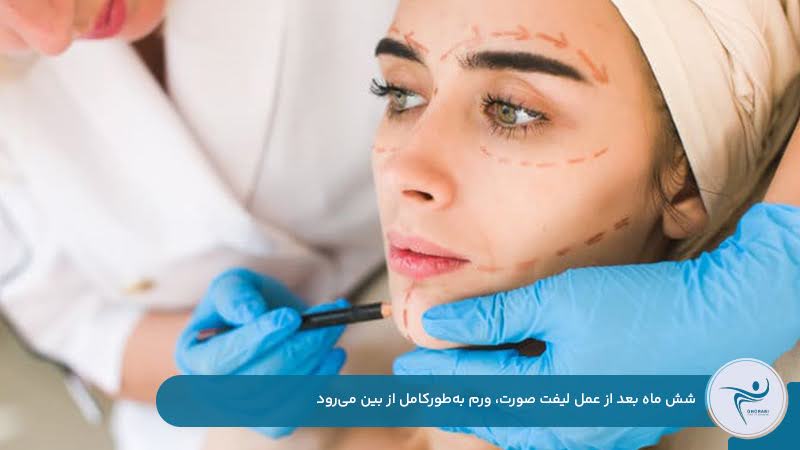 کاهش ورم بعد از عمل لیفت صورت در طی شش ماه