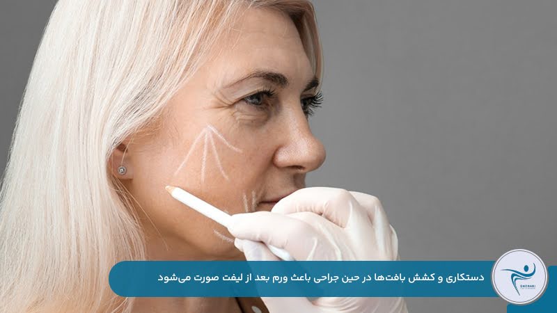 دستکاری و کشش بافت‌ها در حین جراحی دلیل ورم بعد از لیفت صورت