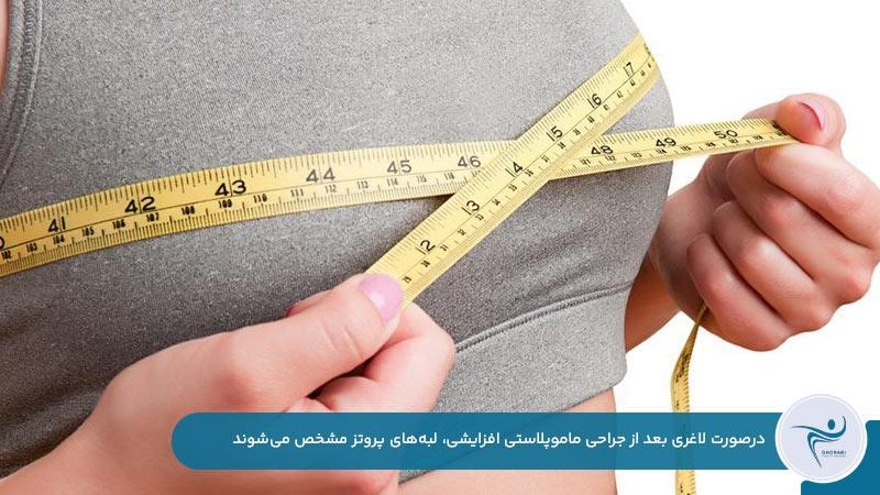 مشخص شدن لبه‌های پروتز به دلیل لاغری بعد از ماموپلاستی افزایشی