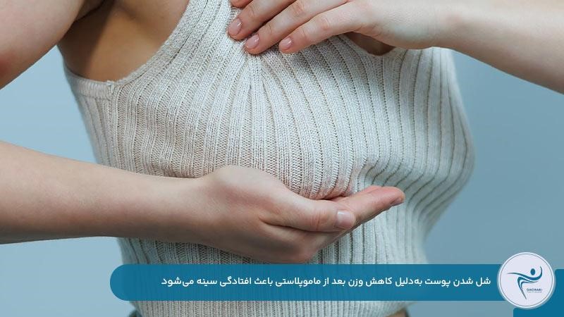 افتادگی سینه به‌دلیل لاغری بعد از ماموپلاستی 