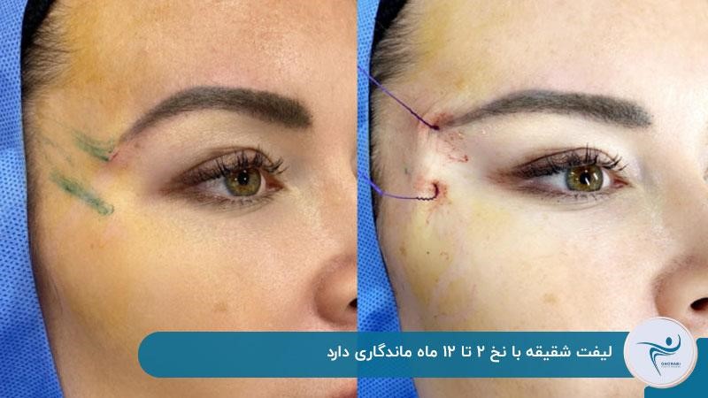 لیفت شقیقه با نخ چقدر ماندگاری دارد؟