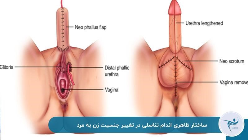 تغییر اندام تناسلی در تغییر جنسیت زن به مرد