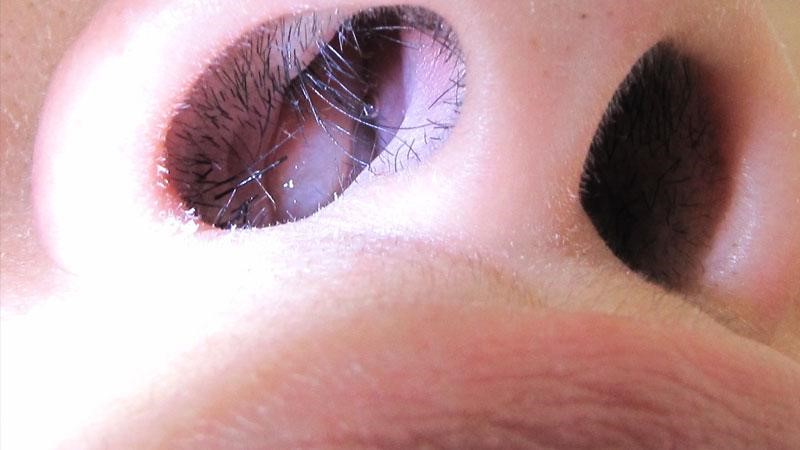 از کجا بفهمیم پولیپ بینی داریم