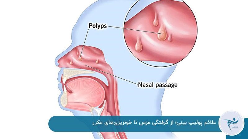 از کجا بفهمم پولیپ بینی دارم
