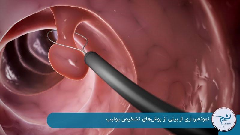 نمونه‌برداری از بینی از روش‌های تشخیص پولیپ