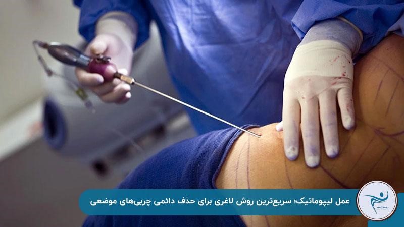 لاغری سریع با عمل لیپوماتیک