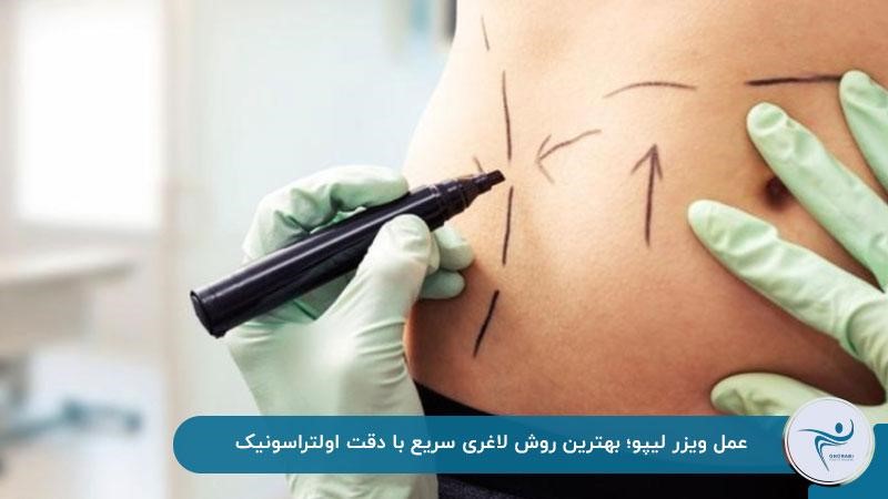 ویزر لیپو بهترین روش لاغری سریع