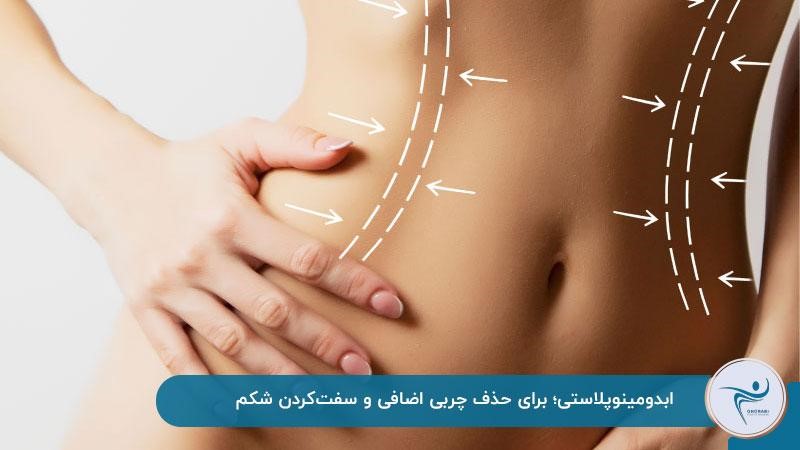 ابدومینوپلاستی برای حذف چربی اضافی شکم