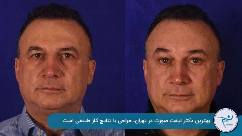 نمونه کار دکتر غرابی بهترین جراح لیفت صورت تهران
