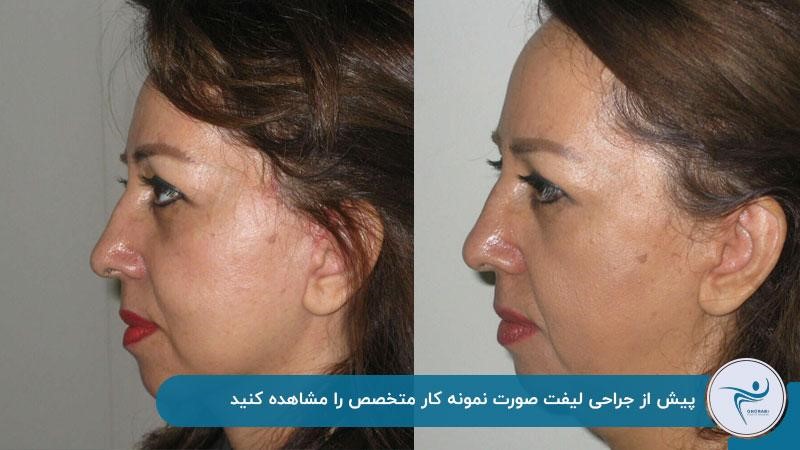 عکس نمونه جراحی لیفت صورت